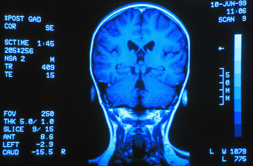 Gyro Scan Of The Back Of Brain