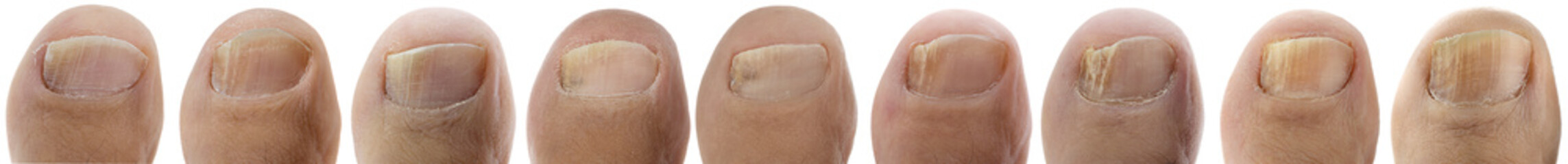 Ringworm of the Nail Sequence Isolated