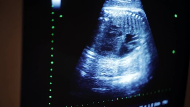 Obstetric ultrasound fetus of a pregnant woman