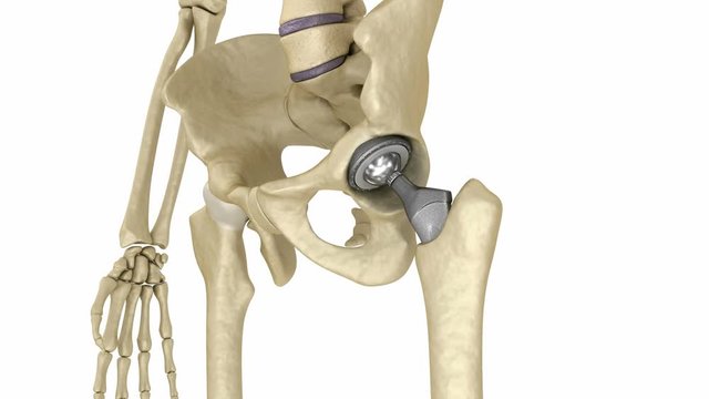 Hip replacement implant installed in the pelvis bone. Medically accurate  3D animation