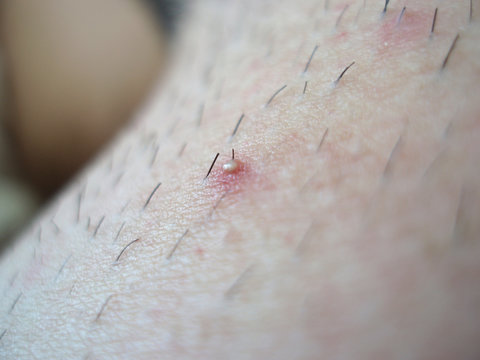 pimple