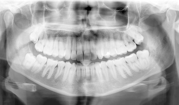 Dental X-Ray of teeth