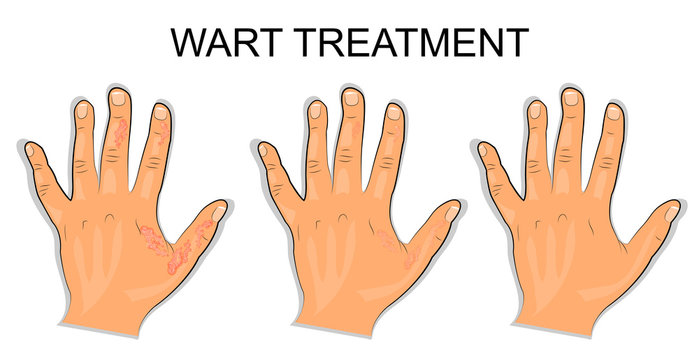 hand affected by the wart