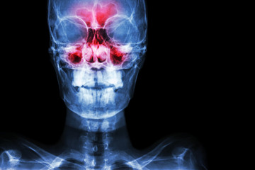 Sinusitis. film x-ray skull AP ( anterior - posterior ) show infection and inflammation at frontal...