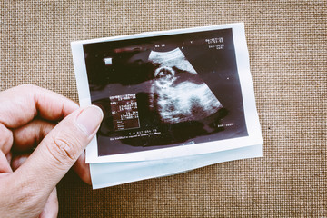 Photo of an ultrasound sonogram of an unborn baby
