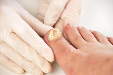 checking the disease big toe