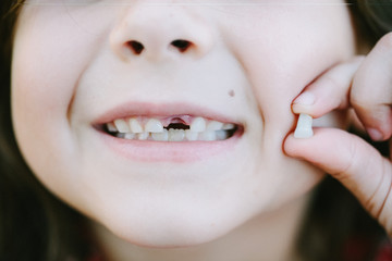 Young girl with one missing milk tooth.