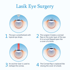 Lasik eye surgery. Vector Illustration - obrazy, fototapety, plakaty