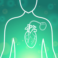 Heart with pacemaker medical wallpaper,vector illustration.Human Heart logo and Heart Pacemaker lifesaver on green blur pattern human silhouette. Medical wallpaper for medical site,cardiology clinic