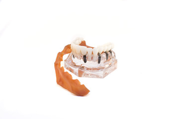 glass jaw model with implanted dentures