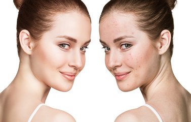 Girl with acne before and after treatment - 124688822