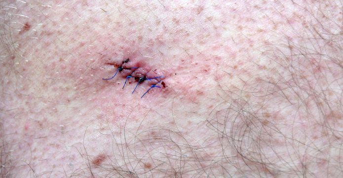 frisch gen&auml;ht ist halb verheilt