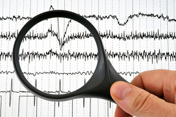 Un électrocardiogramme examiné à la loupe