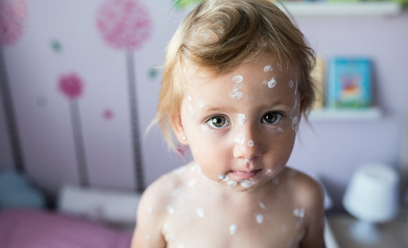 Little girl with chickenpox, antiseptic cream applied to rash