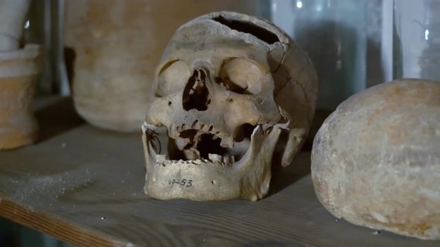 Human Skull in a Chemist's Shop. This Human Skull With Traces of Medical Intervention