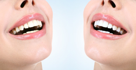 Fototapeta premium Demonstration of dental whitening result, before and after procedure. Dentistry concept.