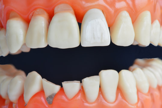 Zähne, Zahn, Zahnmodell, Symbol, Zahnpflege, Zahnarzt, Zahnersatz, Implantat, Zahnmedizin, Heil- und Kostenplan, Mundhygiene, Prophylaxe