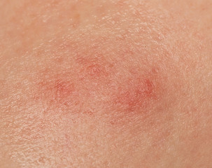 Fototapeta premium redness of the skin from a mosquito bite