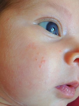 Acne neonatale.