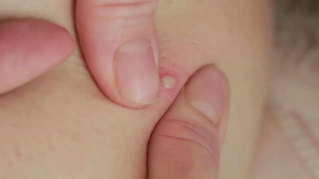 macro texture of burns on human skin back. wound treatment