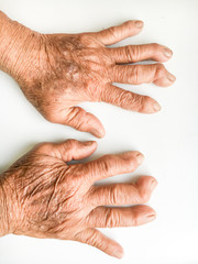 hands of Rheumatoid Arthritis patient on White Background - obrazy, fototapety, plakaty