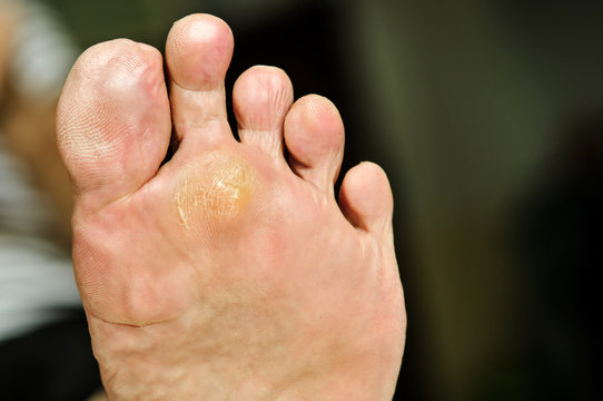 wart under foot can treatment by salicylic acid.