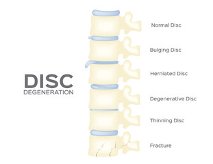 spine disc degeneration vector . back bone . anatomy
