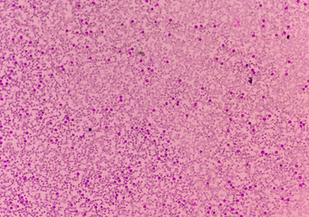 Moderate white blood cells  mature neutrophil and band form neut