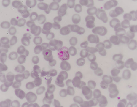 blood films for Malaria parasite