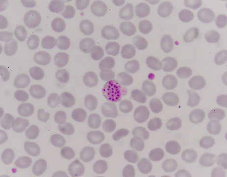 blood films for Malaria parasite