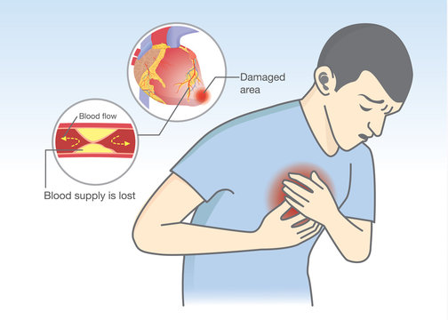 Man have early symptoms of heart attack. Blood flow get blocked by fatty which that is cause angina and heart attack. Healthcare and medical illustration.
