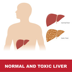 vector illustration of comparison of healthy and toxic liver