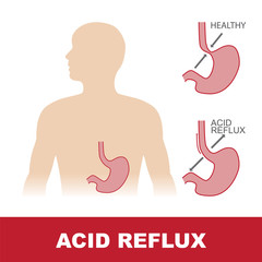 vector illustration of comparison of healty stomach and with acid reflux