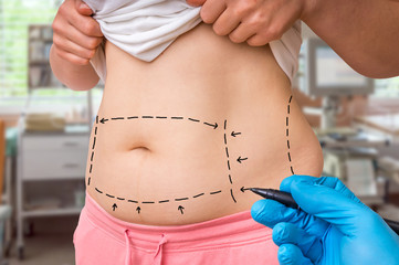 Plastic surgery doctor draw lines with marker on patient belly