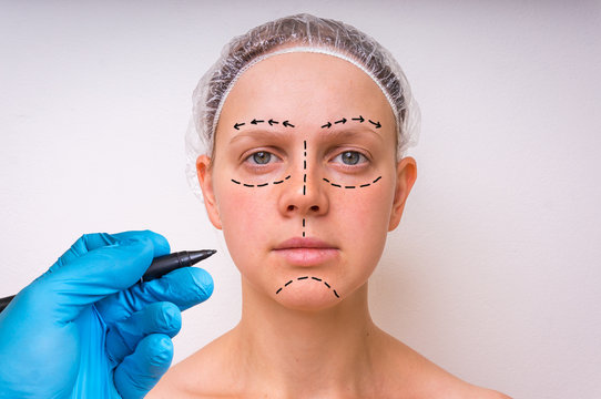 Plastic Surgery Doctor Draw Lines With Marker On Patient Face