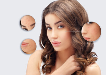  Post-Acne Marks /Treating Acne Scars