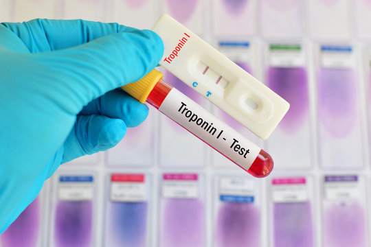 Troponin I Testing By Using Rapid Test Cassette 
