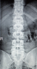 Spine injury spinal pain xray