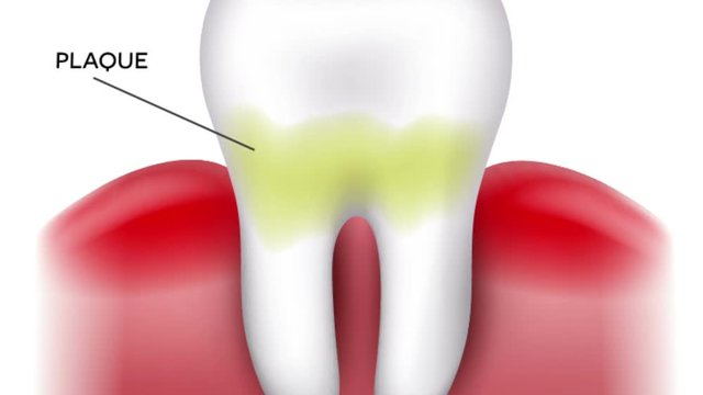 Dental caries formation, dental plaque, loss of calcium, phosphate and finally caries and cavity