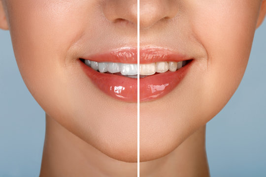 Female teeth whitening before and after the procedure, big lips mouth open, straight beautiful teeth. brush your teeth. Beautiful Smile for woman's face. White smooth natural teeth. Blue background