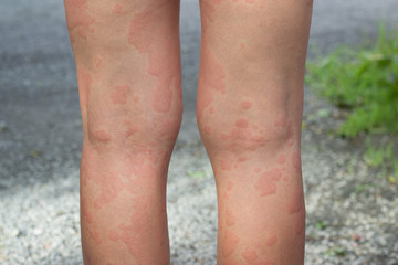 skin allergies, legs skin women.