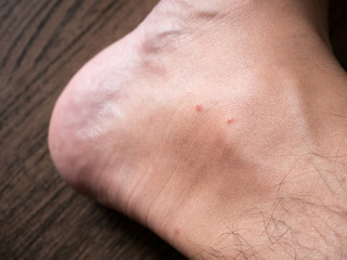 Naklejka premium Red spot on adult leg. Mosquito bite is to be awareness to preve