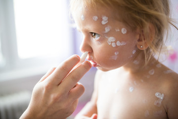 Girl with chickenpox, antiseptic cream applied to the ras