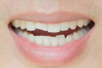 Trauma and Nerve Damage of injured tooth, Permanent Teeth Injury.
