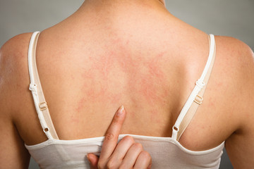 woman scratching her itchy back with allergy rash