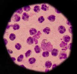 Cancer Cell in human showing abnormal cells.