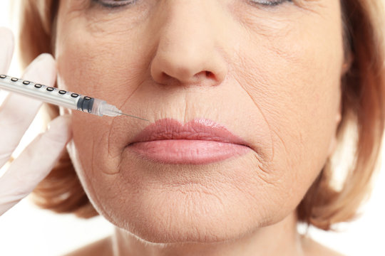 Procedure of lips augmentation with hyaluronic acid injection