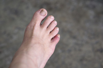 Bruises on woman toe