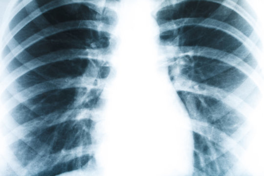 X-ray of human lung closeup