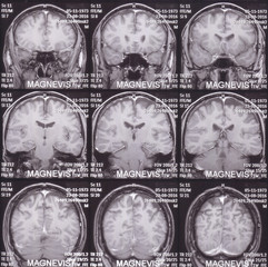 MRI scan image oh human brain